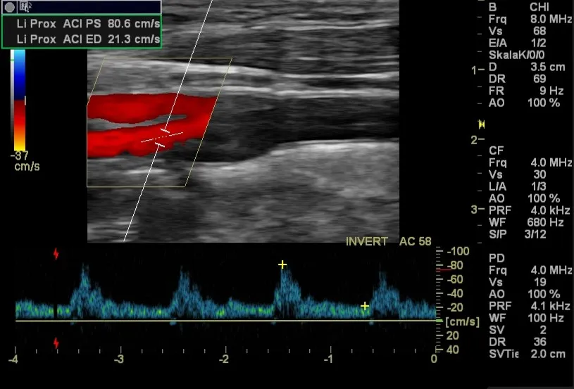 Doppler- und Duplexsonografie der Halsgefäße in der Praxis Dr. Sirkis, Eschborn
